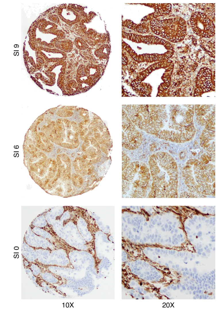 Vimentin immunohistochemistry of endometrial tumour tissue at three staining intensities